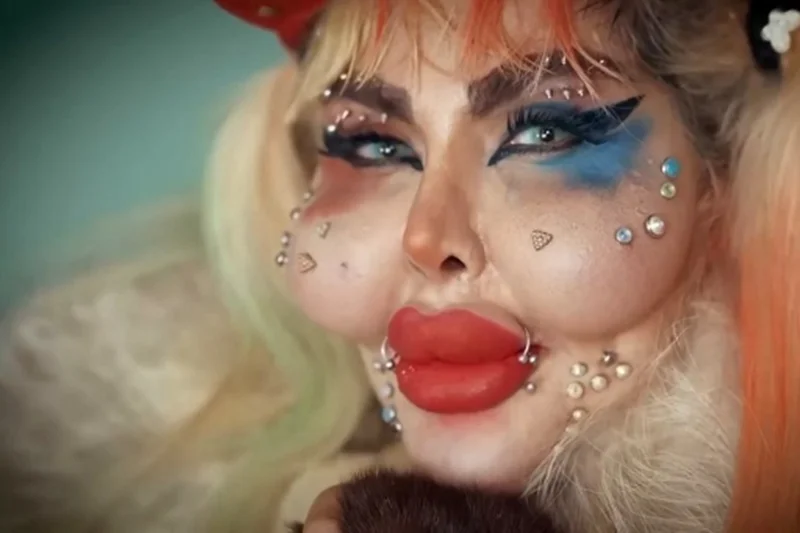 عکس قبل عمل اناهیتا ناچو