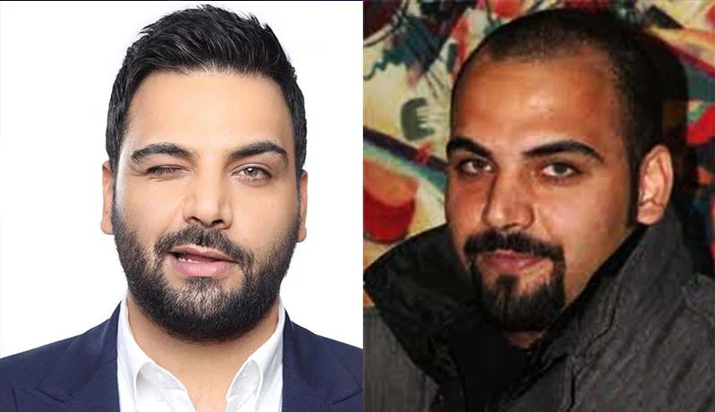 احسان علیخانی قبل از کاشت مو